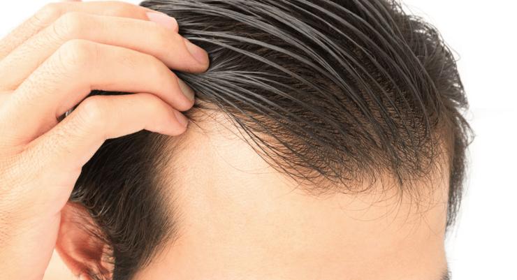 Welcher Arzt hilft bei Haarausfall